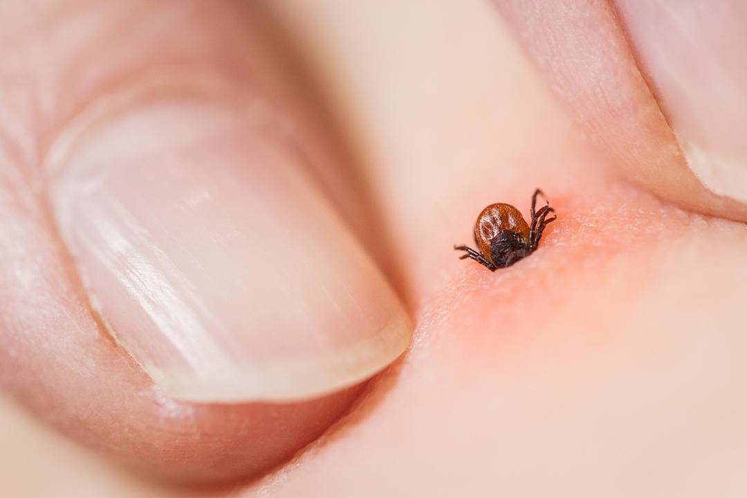 老人离世,儿子睡其生前床上确诊同症!医生:蜱虫病毒引发“母子同病”